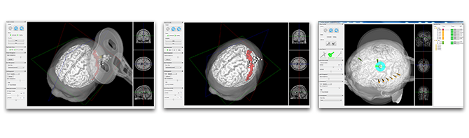 EB Neur Magnetic Stimulation Screens